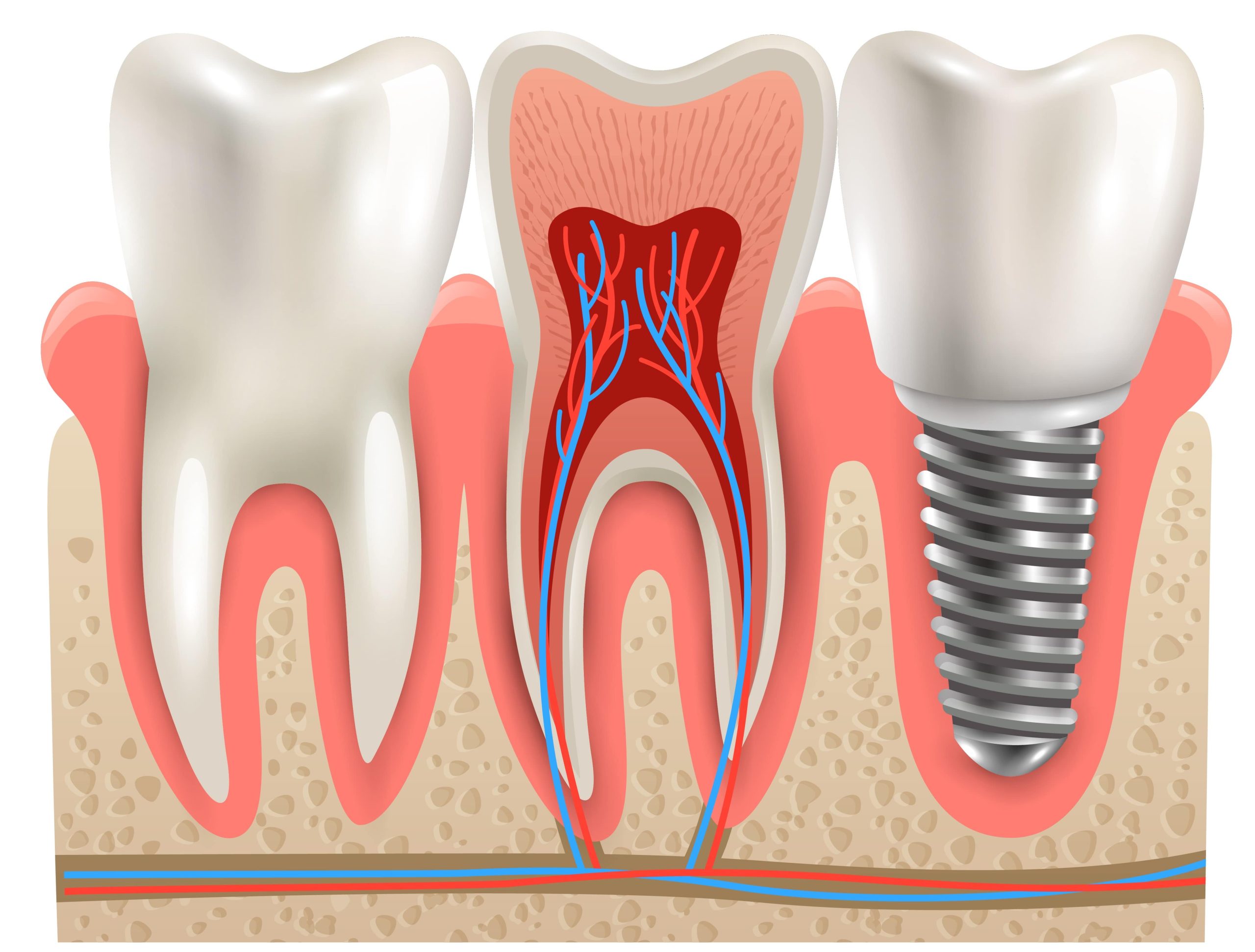 implantes dentales