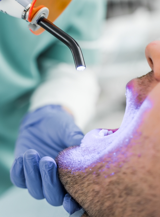 Dental Whitening 2 - Cas Dental