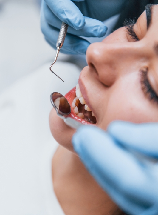 Veneers 2 - Cas Dental