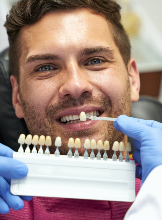 Veneers 1 - Cas Dental