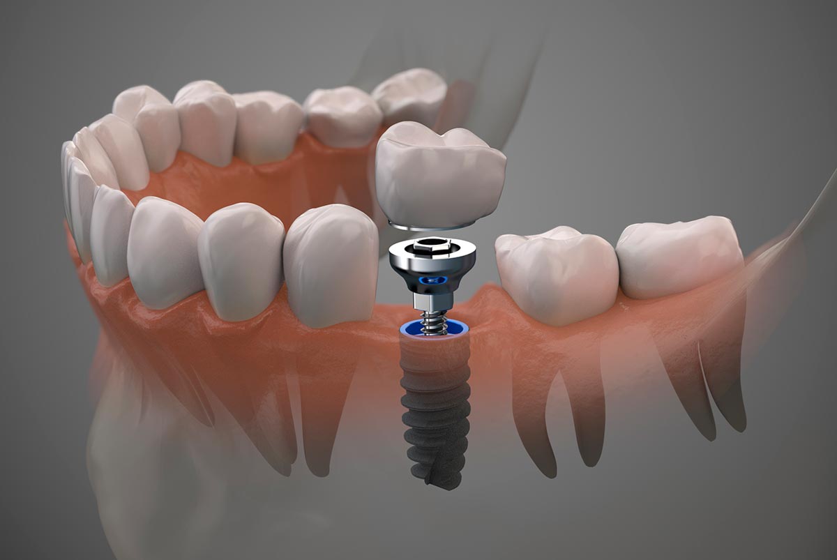 Implantes dentales en Ayamonte: cuándo son necesarios y qué debes saber antes del tratamiento
