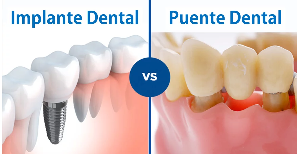 Implante dental o puente: ¿qué opción dura más?