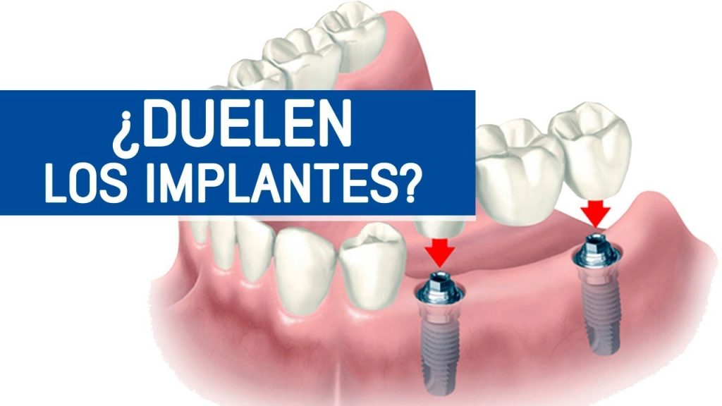 ¿Duele ponerse un implante dental? Todo lo que debes saber