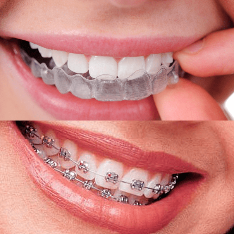 Invisalign o brackets: qué tratamiento elegir según tu caso